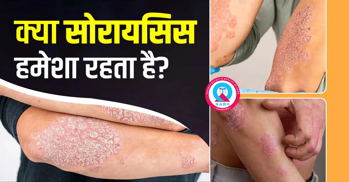 क्या-सोरायसिस-हमेशा-रहता-है